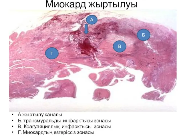 Миокард жыртылуы А.жыртылу каналы Б. трансмуральды инфарктысы зонасы В. Коагуляциялық инфарктысы