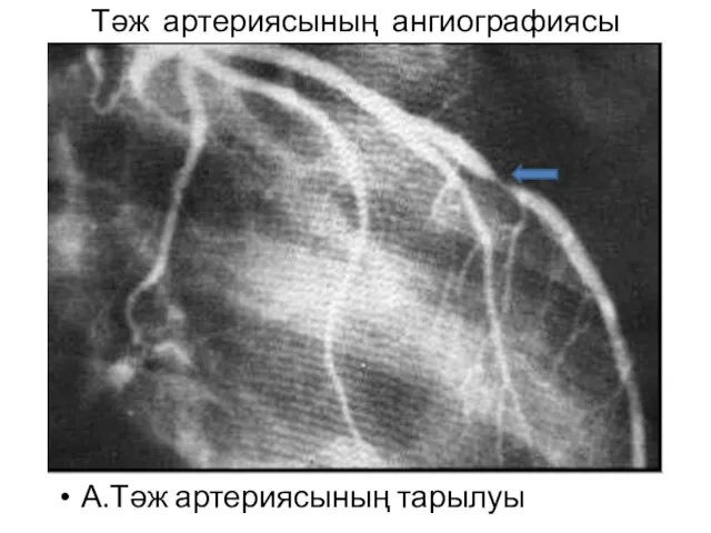 Тәж артериясының ангиографиясы А.Тәж артериясының тарылуы