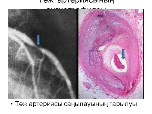 Тәж артериясының ангиографиясы Тәж артериясы саңылауының тарылуы