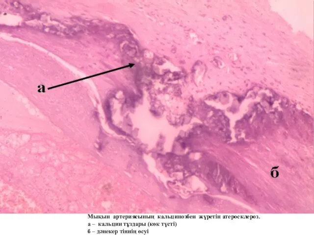 Мықын артериясының кальцинозбен жүретін атеросклероз. а – кальции тұздары (көк түсті) б – дәнекер тіннің өсуі