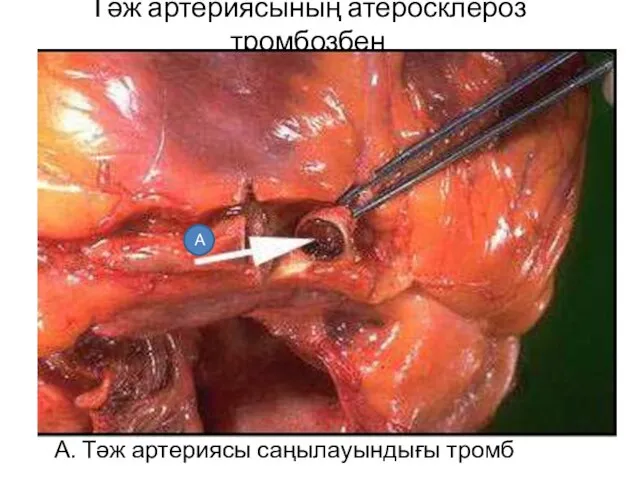 Тәж артериясының атеросклероз тромбозбен А. Тәж артериясы саңылауындығы тромб А