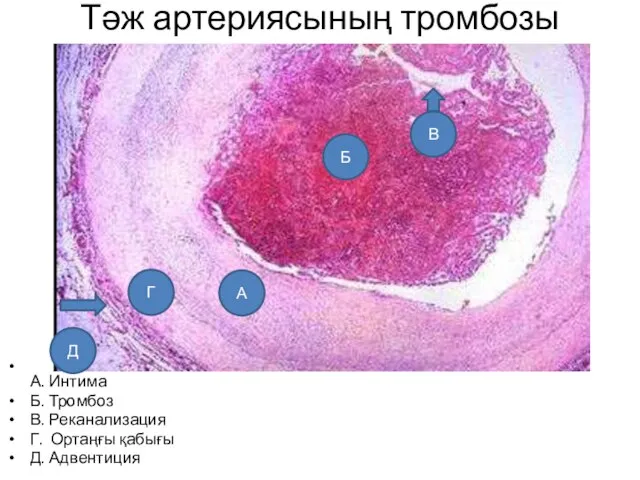 Тәж артериясының тромбозы А. Интима Б. Тромбоз В. Реканализация Г. Ортаңғы