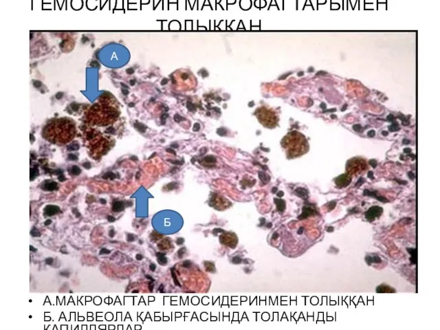 ГЕМОСИДЕРИН МАКРОФАГТАРЫМЕН ТОЛЫҚҚАН А.МАКРОФАГТАР ГЕМОСИДЕРИНМЕН ТОЛЫҚҚАН Б. АЛЬВЕОЛА ҚАБЫРҒАСЫНДА ТОЛАҚАНДЫ КАПИЛЛЯРЛАР А Б