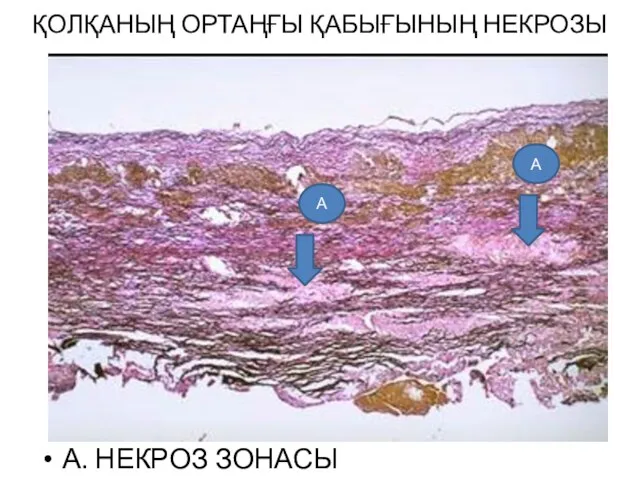 ҚОЛҚАНЫҢ ОРТАҢҒЫ ҚАБЫҒЫНЫҢ НЕКРОЗЫ А. НЕКРОЗ ЗОНАСЫ А А