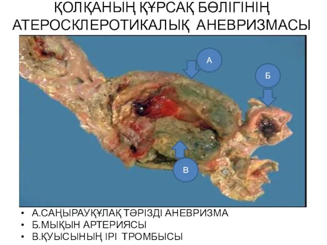 ҚОЛҚАНЫҢ ҚҰРСАҚ БӨЛІГІНІҢ АТЕРОСКЛЕРОТИКАЛЫҚ АНЕВРИЗМАСЫ А.САҢЫРАУҚҰЛАҚ ТӘРІЗДІ АНЕВРИЗМА Б.МЫҚЫН АРТЕРИЯСЫ В.ҚУЫСЫНЫҢ ІРІ ТРОМБЫСЫ Б А В