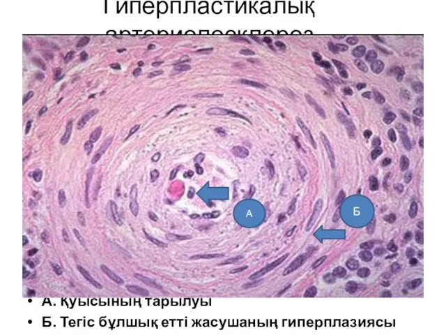 Гиперпластикалық артериолосклероз А. Қуысының тарылуы Б. Тегіс бұлшық етті жасушаның гиперплазиясы А Б