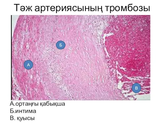 Тәж артериясының тромбозы А.ортаңғы қабықша Б.интима В. қуысы В Б А