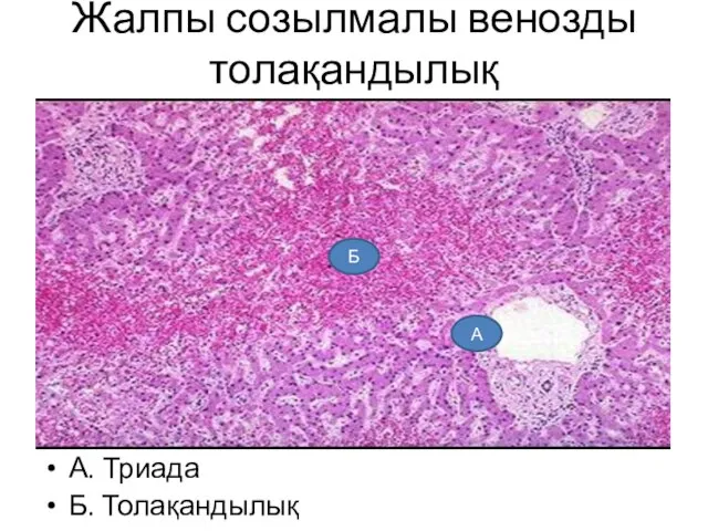 Жалпы созылмалы венозды толақандылық А. Триада Б. Толақандылық А Б