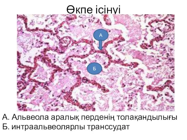 Өкпе ісінуі А. Альвеола аралық перденің толақандылығы Б. интраальвеолярлы транссудат А Б