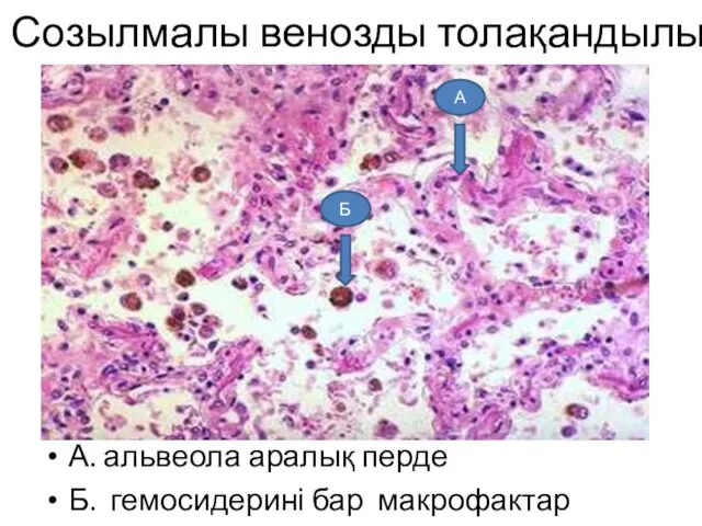 Созылмалы венозды толақандылық А. альвеола аралық перде Б. гемосидерині бар макрофактар А Б