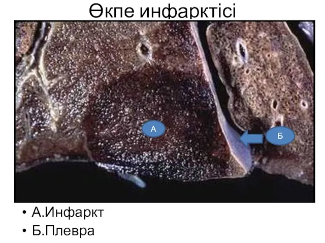 Өкпе инфарктісі А.Инфаркт Б.Плевра Б А