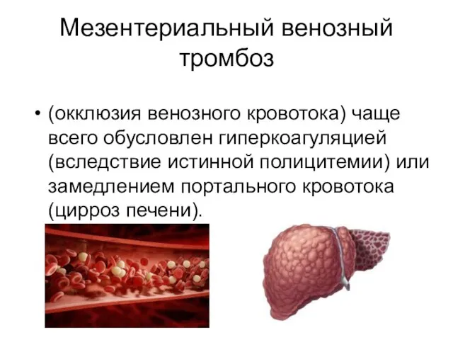 Мезентериальный венозный тромбоз (окклюзия венозного кровотока) чаще всего обусловлен гиперкоагуляцией (вследствие