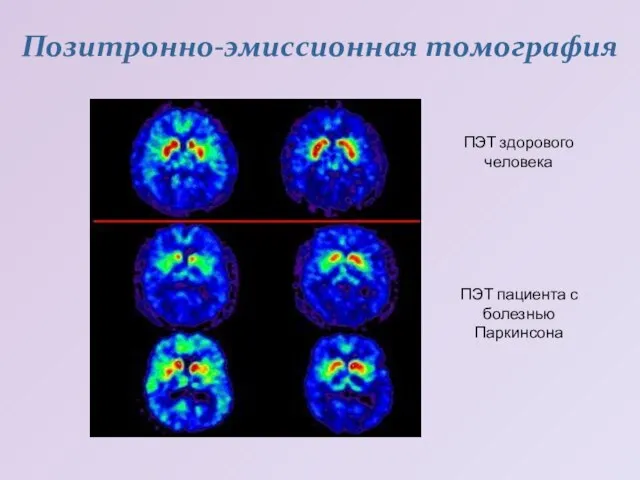 Позитронно-эмиссионная томография ПЭТ здорового человека ПЭТ пациента с болезнью Паркинсона