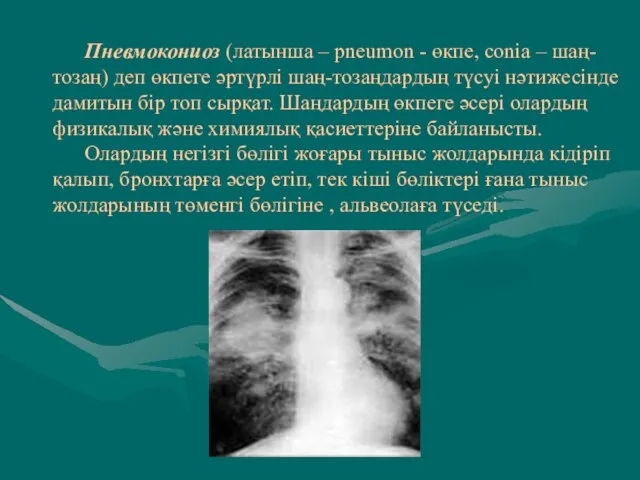 Пневмокониоз (латынша – pneumon - өкпе, conia – шаң- тозаң) деп