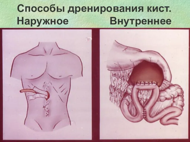 Способы дренирования кист. Наружное Внутреннее