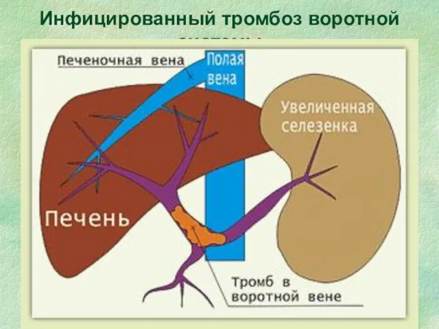 Инфицированный тромбоз воротной системы