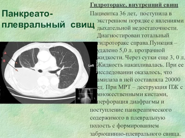 Панкреато-плевральный свищ Гидроторакс, внутренний свищ Пациентка 36 лет, поступила в экстренном