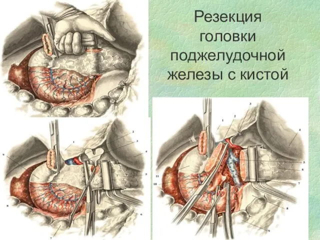 Резекция головки поджелудочной железы с кистой