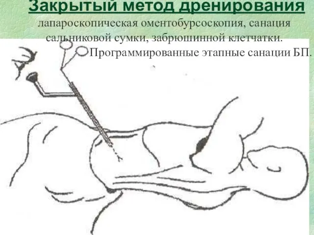 Закрытый метод дренирования лапароскопическая оментобурсоскопия, санация сальниковой сумки, забрюшинной клетчатки. Программированные этапные санации БП.