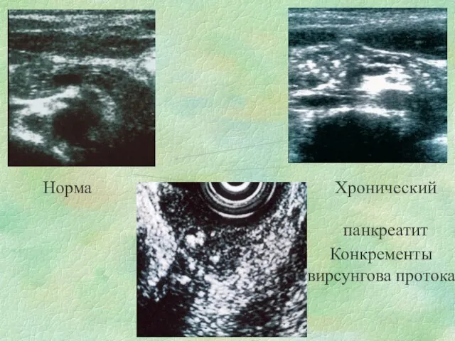 Норма Хронический панкреатит Конкременты вирсунгова протока