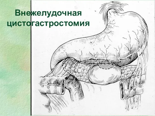 Внежелудочная цистогастростомия