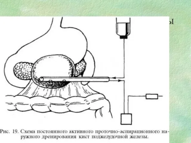 Наружное дренирование кисты