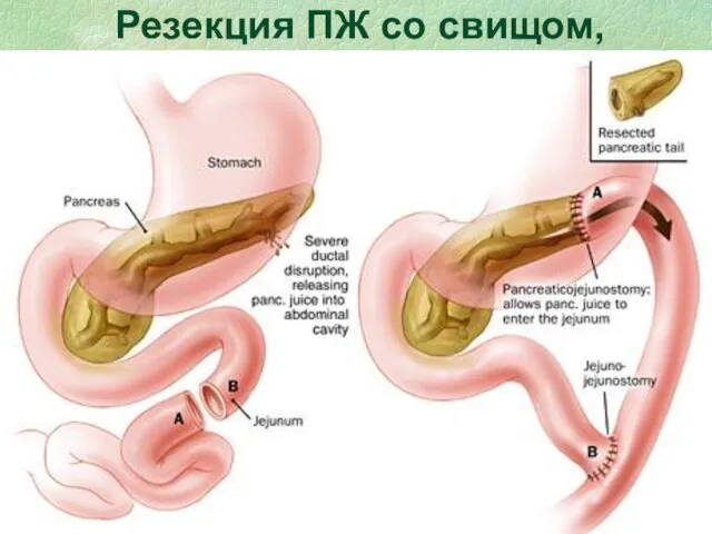 Резекция ПЖ со свищом, панкреатоеюностомия