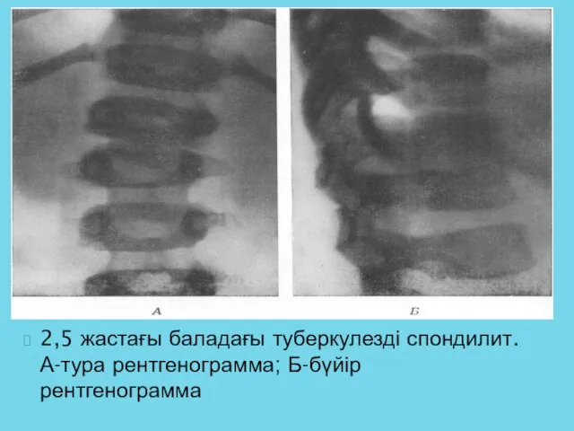 2,5 жастағы баладағы туберкулезді спондилит. А-тура рентгенограмма; Б-бүйір рентгенограмма