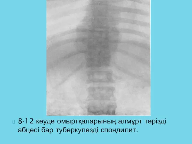 8-12 кеуде омыртқаларының алмұрт тәрізді абцесі бар туберкулезді спондилит.