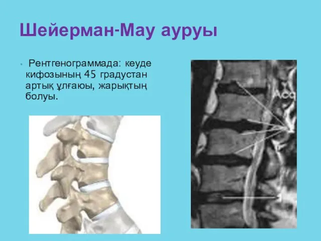 Рентгенограммада: кеуде кифозының 45 градустан артық ұлғаюы, жарықтың болуы. Шейерман-Мау ауруы