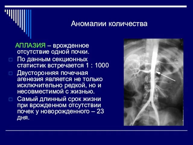 Аномалии количества АПЛАЗИЯ – врожденное отсутствие одной почки. По данным секционных