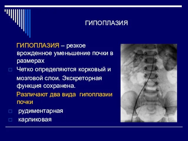 ГИПОПЛАЗИЯ ГИПОПЛАЗИЯ – резкое врожденное уменьшение почки в размерах Четко определяются