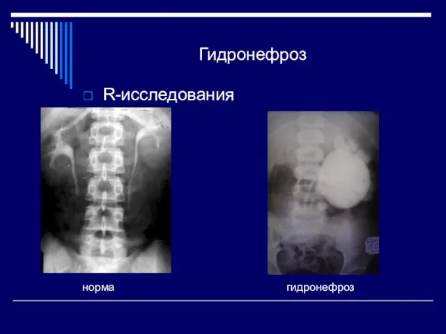 Гидронефроз R-исследования норма гидронефроз