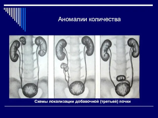 Аномалии количества Схемы локализации добавочной (третьей) почки