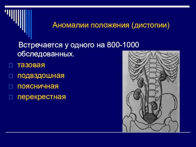 Аномалии положения (дистопии) Встречается у одного на 800-1000 обследованных. тазовая подвздошная поясничная перекрестная