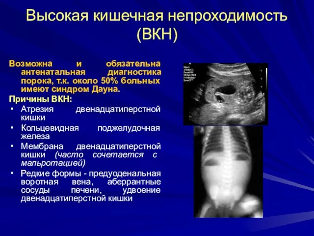 Высокая кишечная непроходимость (ВКН) Возможна и обязательна антенатальная диагностика порока, т.к.