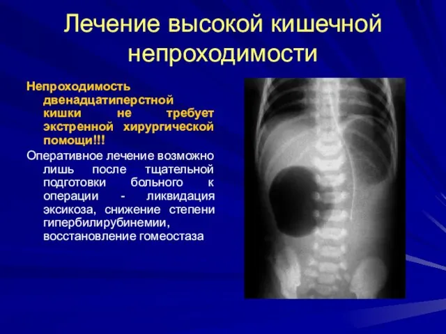 Лечение высокой кишечной непроходимости Непроходимость двенадцатиперстной кишки не требует экстренной хирургической