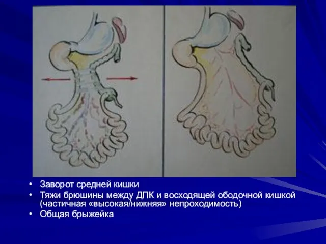 Заворот средней кишки Тяжи брюшины между ДПК и восходящей ободочной кишкой (частичная «высокая/нижняя» непроходимость) Общая брыжейка