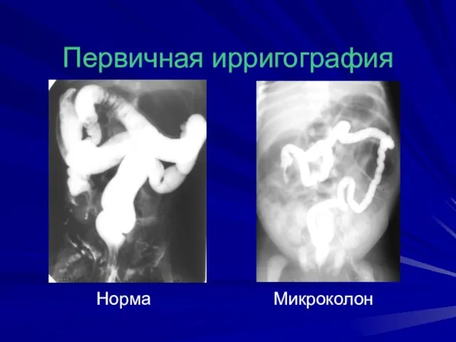 Первичная ирригография Норма Микроколон