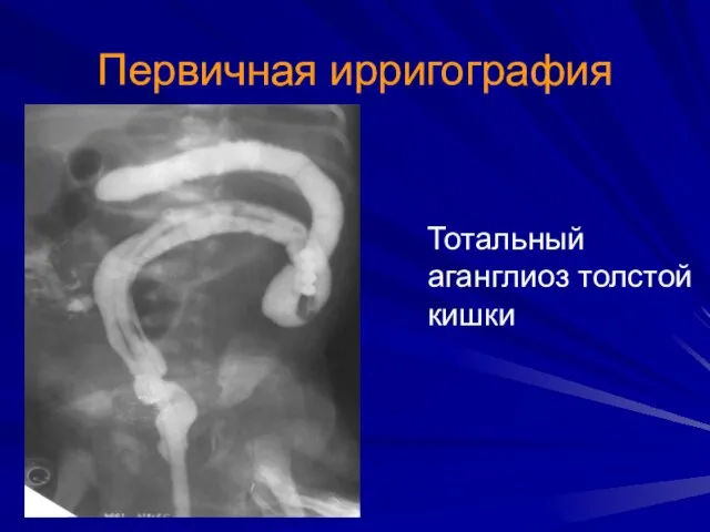 Первичная ирригография Тотальный аганглиоз толстой кишки