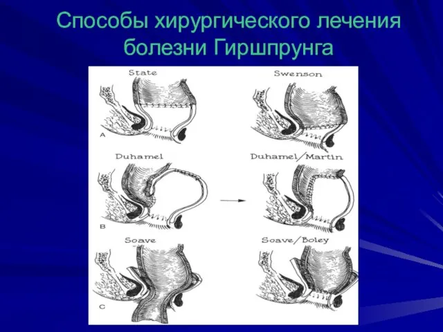 Способы хирургического лечения болезни Гиршпрунга