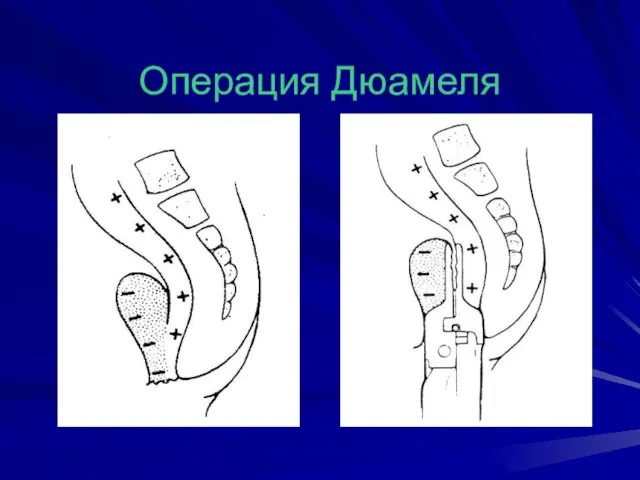 Операция Дюамеля