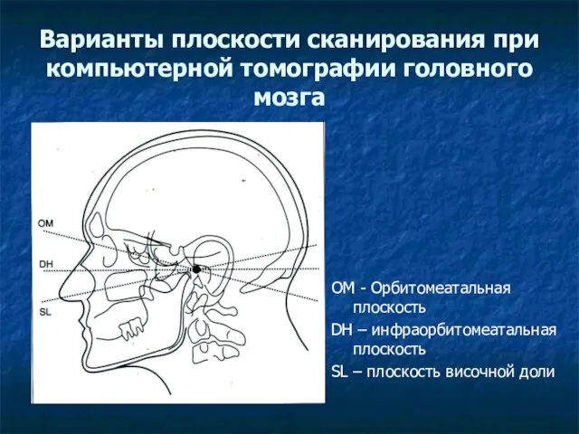 Варианты плоскости сканирования при компьютерной томографии головного мозга ОМ - Орбитомеатальная