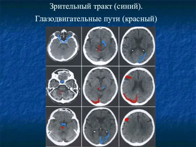 Зрительный тракт (синий). Глазодвигательные пути (красный)