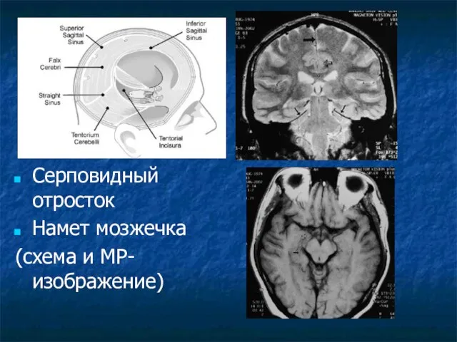 Серповидный отросток Намет мозжечка (схема и МР-изображение)