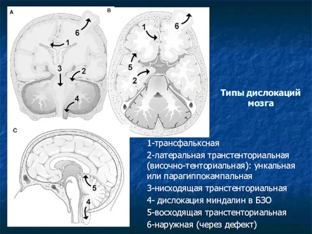 Типы дислокаций мозга 1-трансфальксная 2-латеральная транстенториальная (височно-тенториальная): ункальная или парагиппокампальная 3-нисходящая