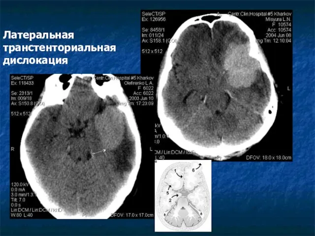 Латеральная транстенториальная дислокация