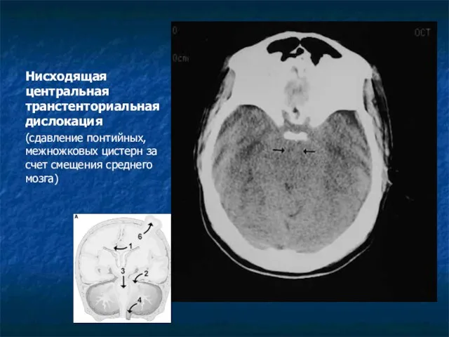 Нисходящая центральная транстенториальная дислокация (сдавление понтийных, межножковых цистерн за счет смещения среднего мозга)