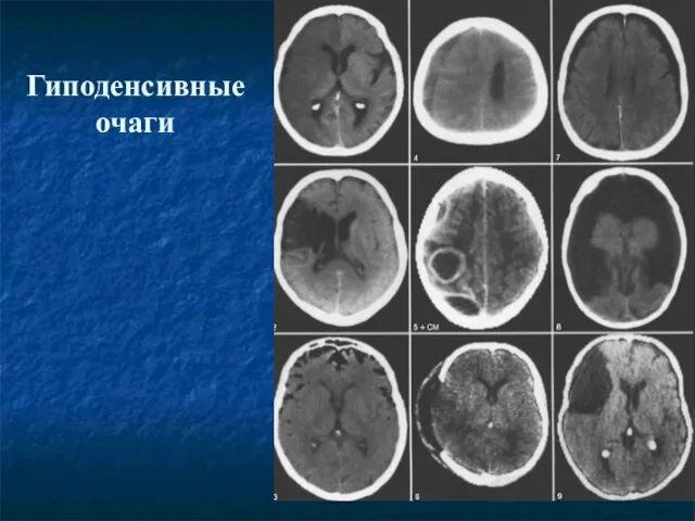 Гиподенсивные очаги