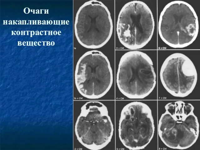 Очаги накапливающие контрастное вещество